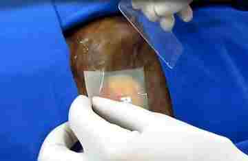 Novo implante injetável pode ser alternativa para reconstrução das mamas